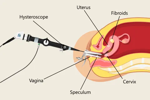 Hysteroscopic Septum Incision Specialist in Andheri West,Mumbai image 1